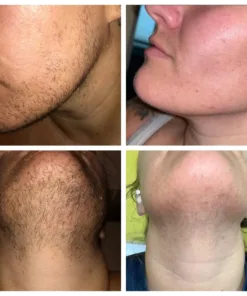 PCOS Facial Hair Solution Serum