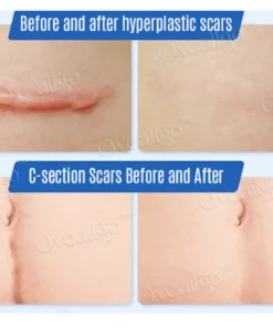 Oveallgo™ SilkScar Scar Treatment & Skin Repair Serum