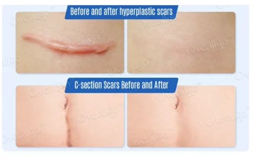 Oveallgo™ SilkScar Scar Treatment & Skin Repair Serum