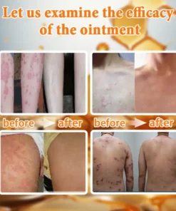 Ourlyard™ Bee Venom Advanced Psoriasis Treatment Cream