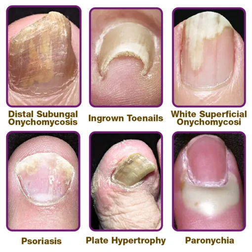 flysmus™ FungiFree Anti-fungal Bee Venom Nail Serum