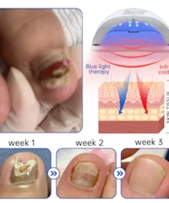 Bikenda™ PureNail Fungus Laser Device