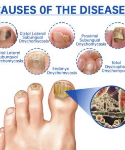 Bikenda™ PureNail Fungus Laser Device