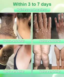 Purifying Exfoliating Gel for Acanthosis Nigricans