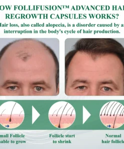 FolliFusion™ Advanced Hair Regrowth Capsules