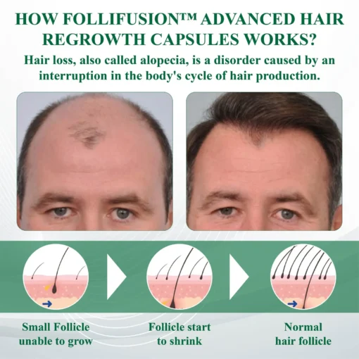 FolliFusion™ Advanced Hair Regrowth Capsules